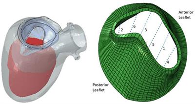 Looking towards the future: patient-specific computational modeling to optimize outcomes for transcatheter mitral valve repair